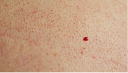 small red pinpoint raised spot on skin